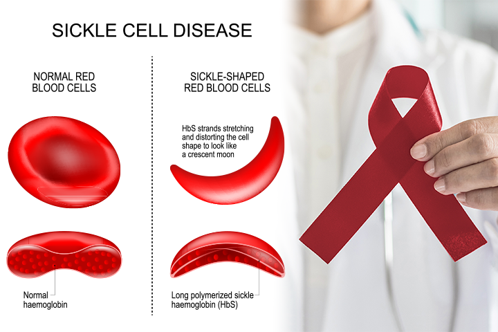diagram showing normal vs. sickle blood cells