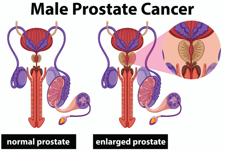 enlarged prostate graphic